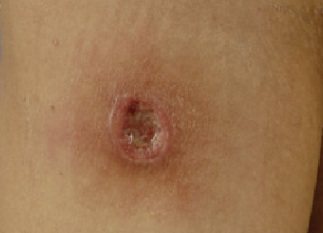 7c6afsyphilis lesion